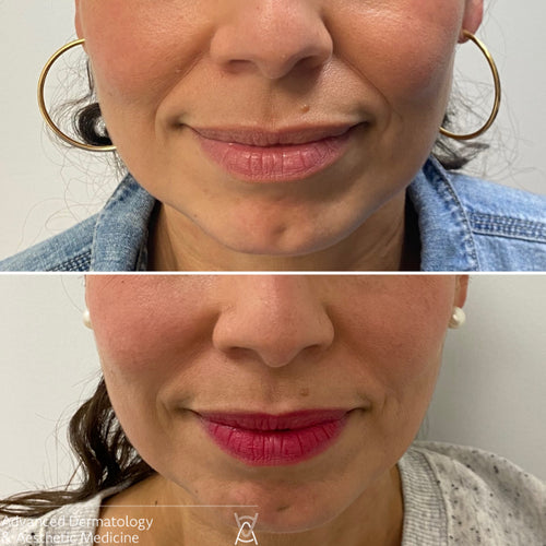 Dermal filler before and after photos, around the mouth, case 31