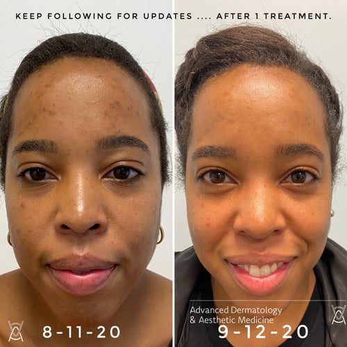 Microneedling before and after photos, face, after one session, case 38