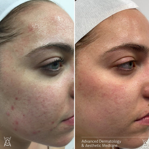 Microneedling before and after photos, cheek, case 39