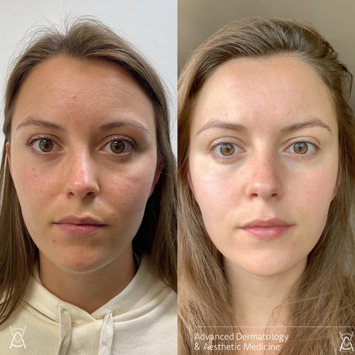 Microneedling before and after photos, face, case 40
