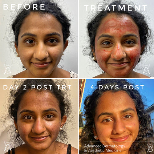Microneedling before and after photos, face, case 48