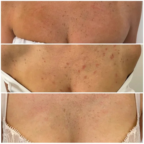 Microneedling before and after photos, chest, case 41