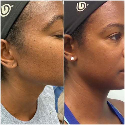 Microneedling before and after photos, cheek, case 42