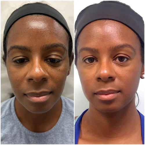 Microneedling before and after photos, face, case 43