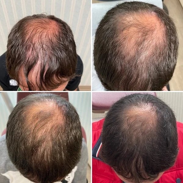PRP for Hair Loss: How This Revolutionary Treatment Stimulates Natural Hair Regrowth