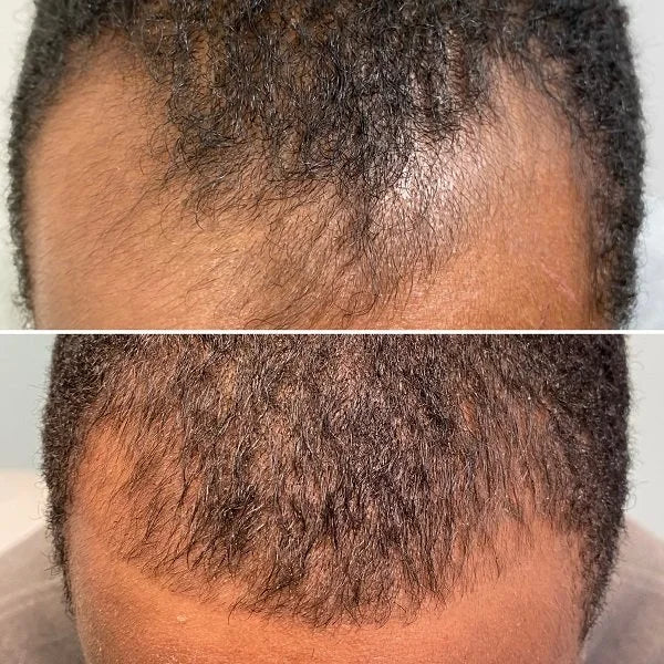 PRP for hair loss before and after photos, front hairline, case 52
