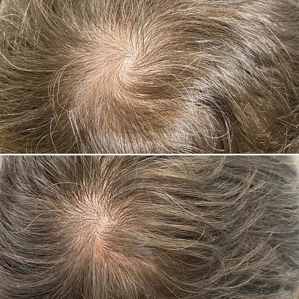 PRP for hair loss before and after photos, crown of the head, case 51