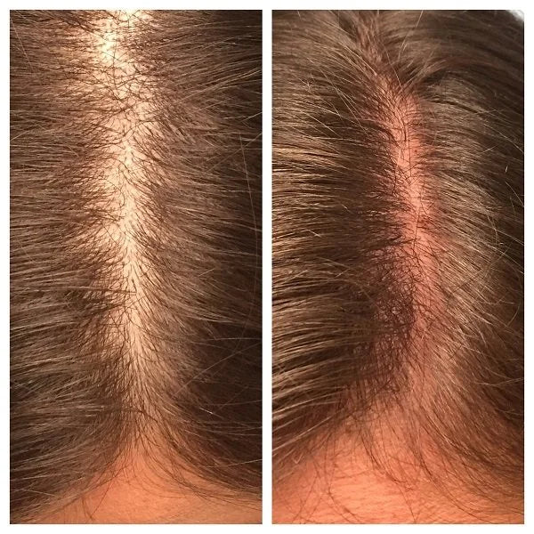 PRP for hair loss before and after photos, part line, case 50