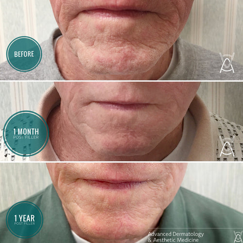 Dermal filler before and after photos, chin, case 27