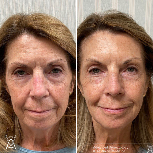 Dermal filler before and after photos, face, case 21
