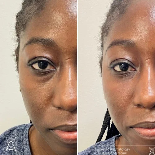 Dermal filler before and after photos, under-eye area, case 25