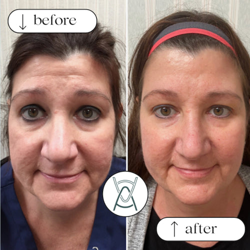 Botox or Dysport before and after photos, forehead lines, case 5
