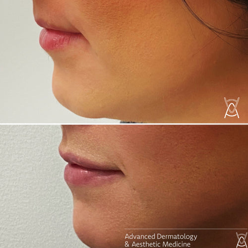 Dermal filler before and after photos, lips and chin, case 30