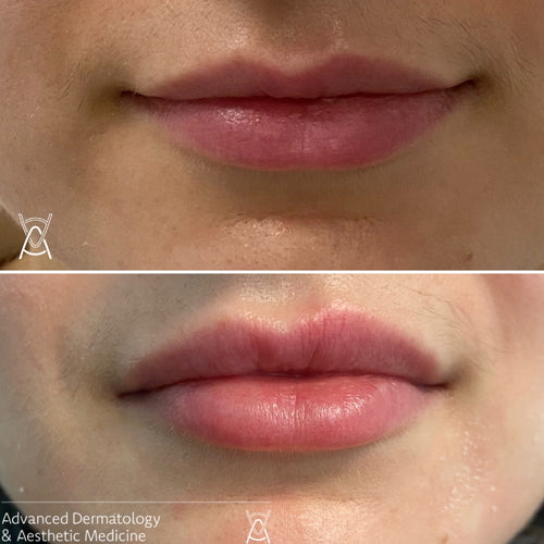 Dermal filler before and after photos, lips, case 26