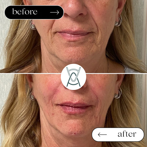 Dermal filler before and after photos, around the mouth, case 28