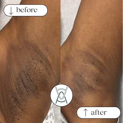 Before and after photos, underarm, case 37