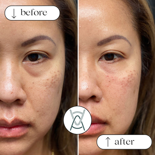 Dermal filler before and after photos, under-eye area, case 23