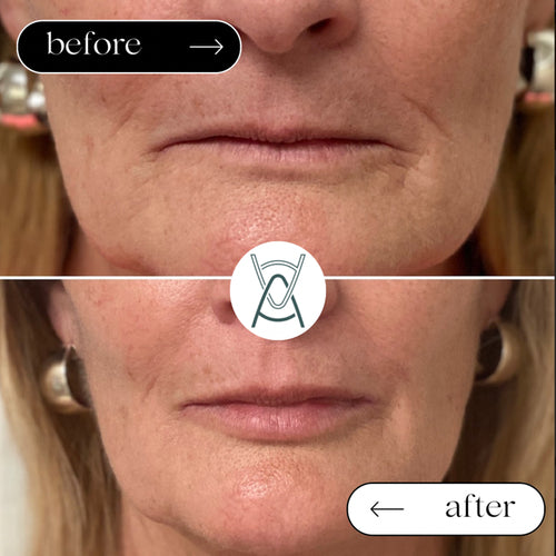 Dermal filler before and after photos, around the mouth, case 22