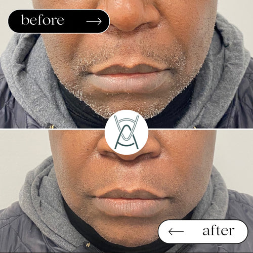 Dermal filler before and after photos, around the mouth, case 29