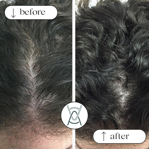PRP for hair loss before and after photos, part line, case 36