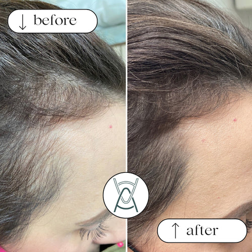 PRP for hair loss before and after photos, temple hairline, case 34