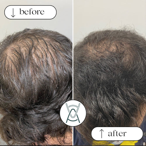 PRP for hair loss before and after photos, crown of the head, case 35
