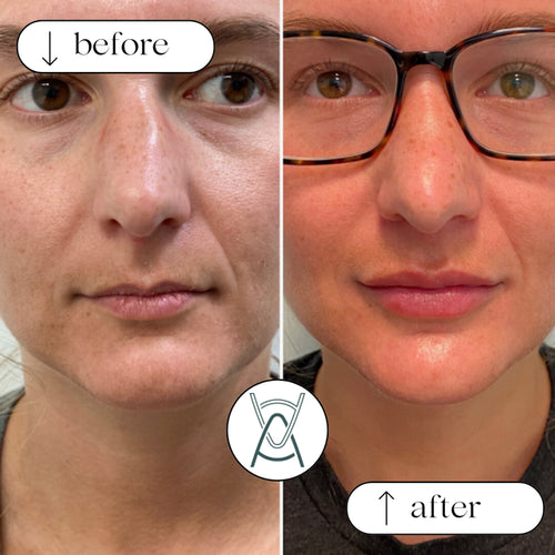 Dermal filler before and after photos, lips, case 24