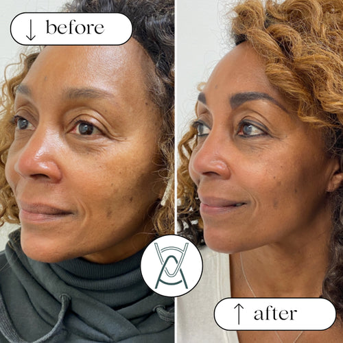 Dermal filler before and after photos, cheek and under-eye area, case 32
