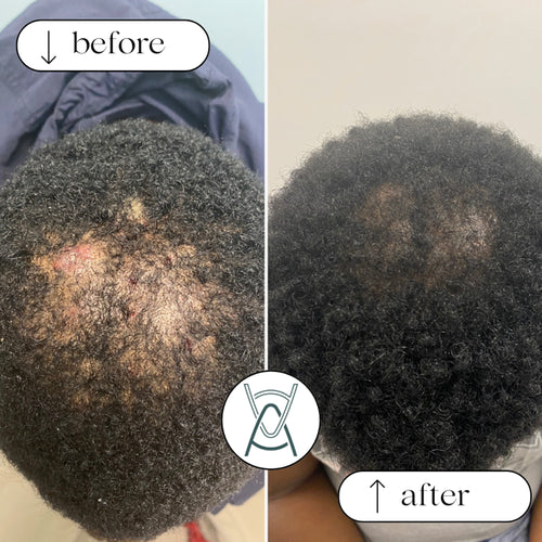 PRP for hair loss before and after photos, crown of the head, case 33